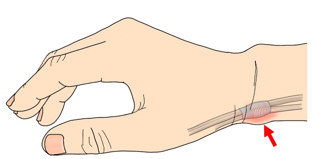 ドケルバン病の原因となる腱鞘の位置イメージ