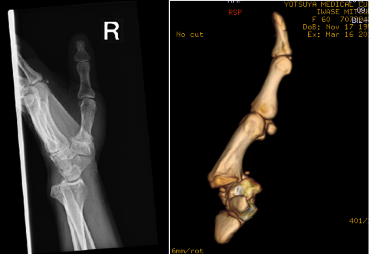 （図1）CM関節亜脱臼