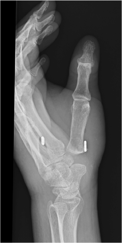 （図2）suture button suspension（Minitight rope Ⓡ suspension）